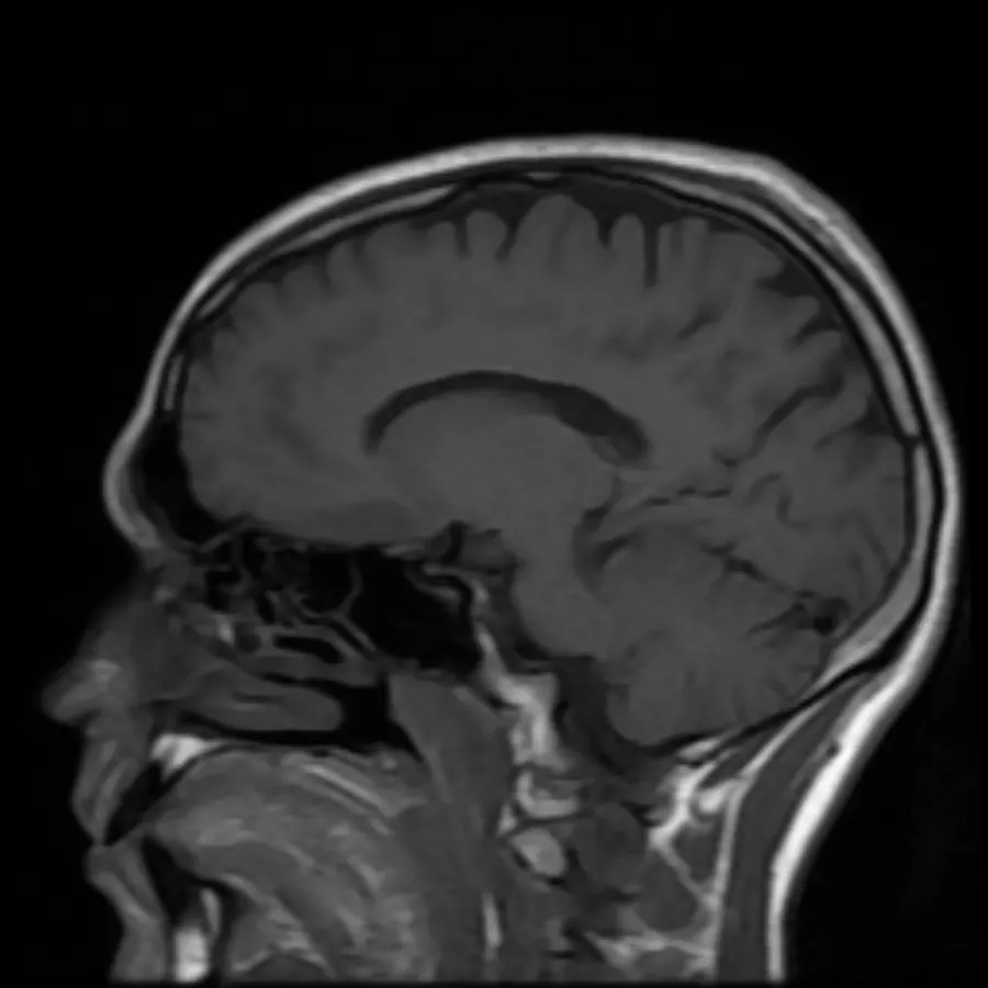 Side-view MRI scan of a human head and brain