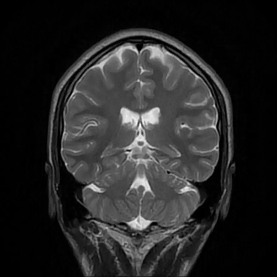 MRI scan of a human brain